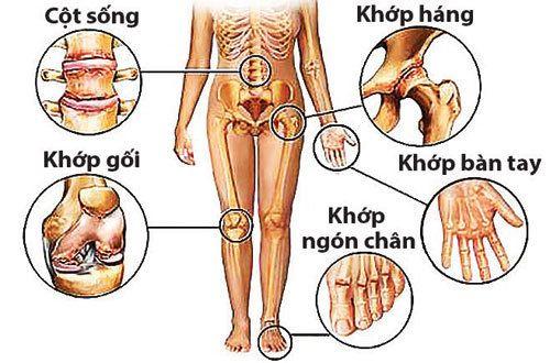 Rối loạn, thoái hóa cơ, xương khớp