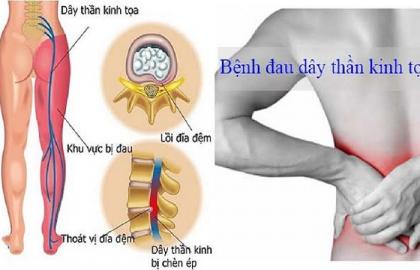 Ghế tựa lưng văn phòng - Giải pháp tối ưu cho người đau thần kinh tọa